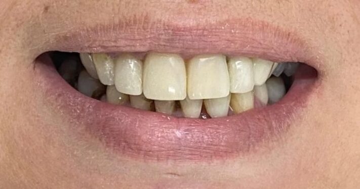 After - Lighthouse Dental