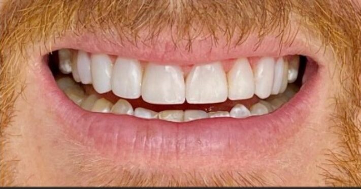After - Lighthouse Dental