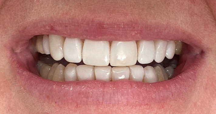 After - Lighthouse Dental