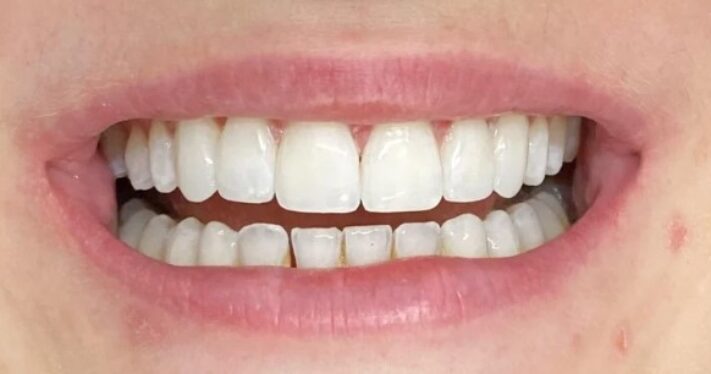 After - Lighthouse Dental