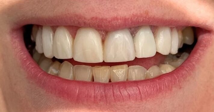 After - Lighthouse Dental