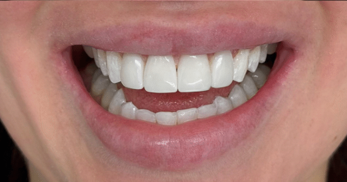 After - Lighthouse Dental