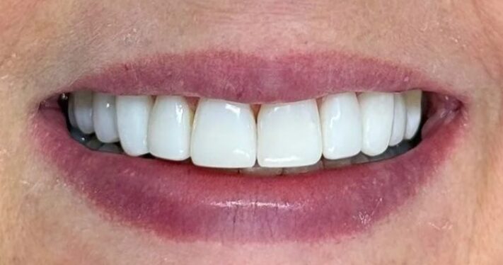 After - Lighthouse Dental