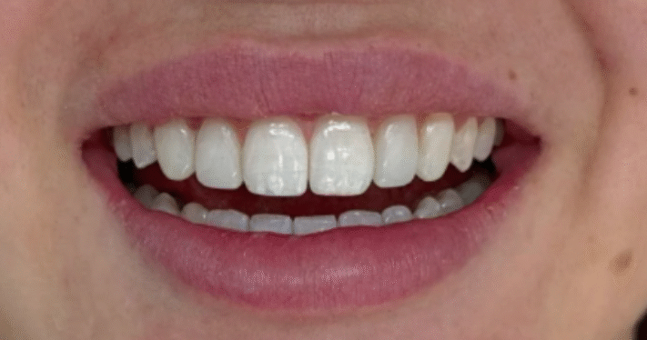 After - Lighthouse Dental