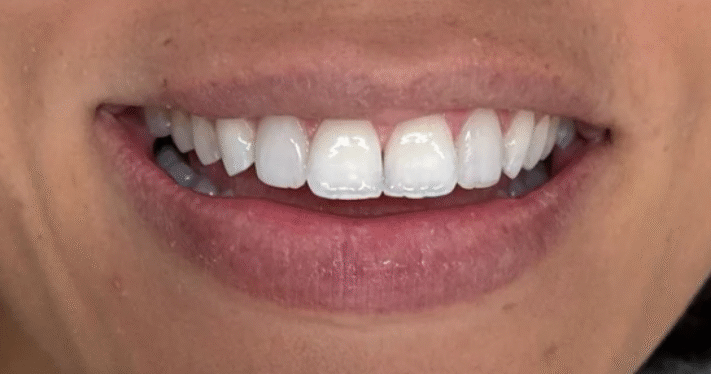 After - Lighthouse Dental