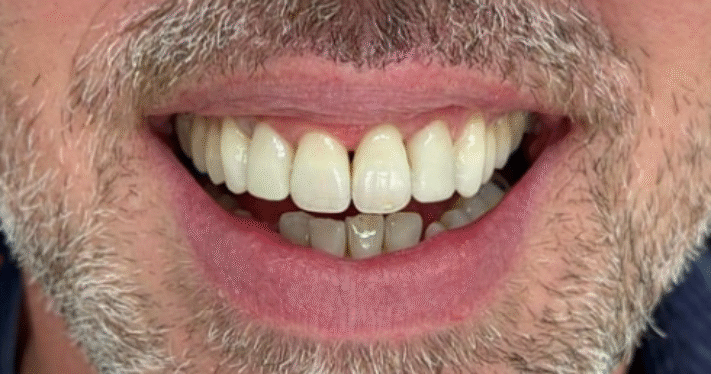 After - Lighthouse Dental