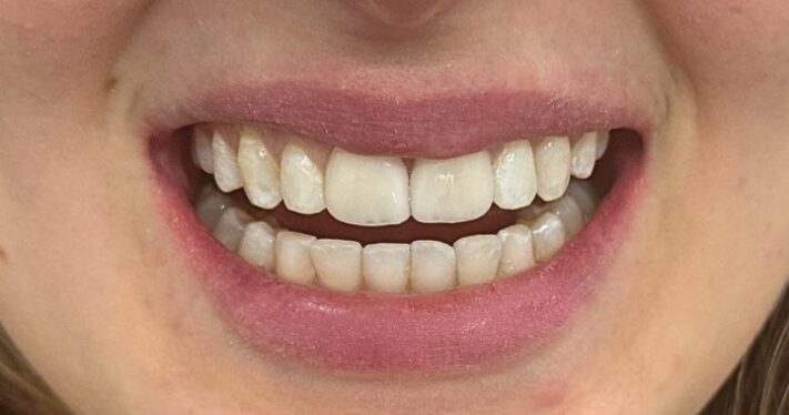 After - Lighthouse Dental