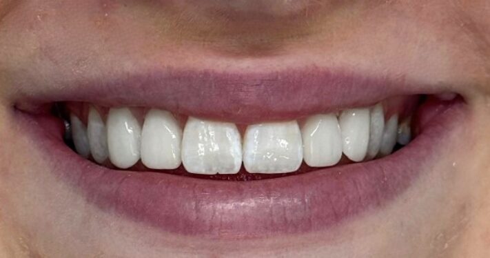 After - Lighthouse Dental